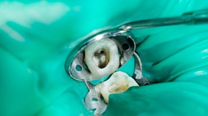 Dental dam covering tooth in DuPont