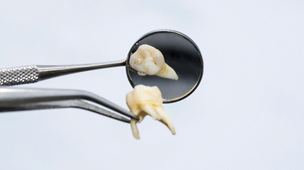 Extracted tooth in DuPont
