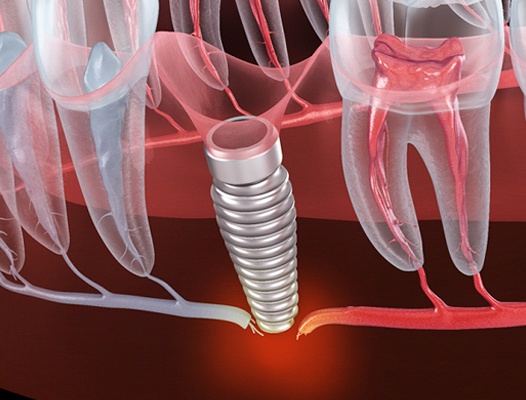 Failed dental implant in Dupont