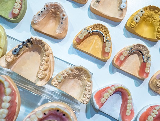 molds of mouths with dentures and partial dentures on them