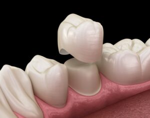 a graphic illustration of a prepared tooth receiving a dental crown